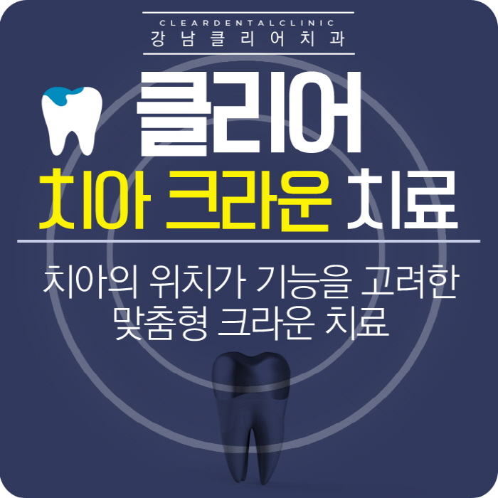 강남 치아 크라운 치료 가격 종류 등 모든것 관련 이미지 1