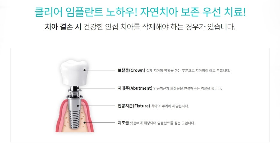강남역 임플란트 한 번으로 기대해봐 관련 이미지 2