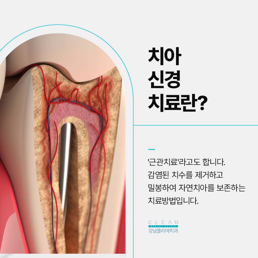 치아 신경치료 통증이 계속 남는다구요? 관련 이미지 2