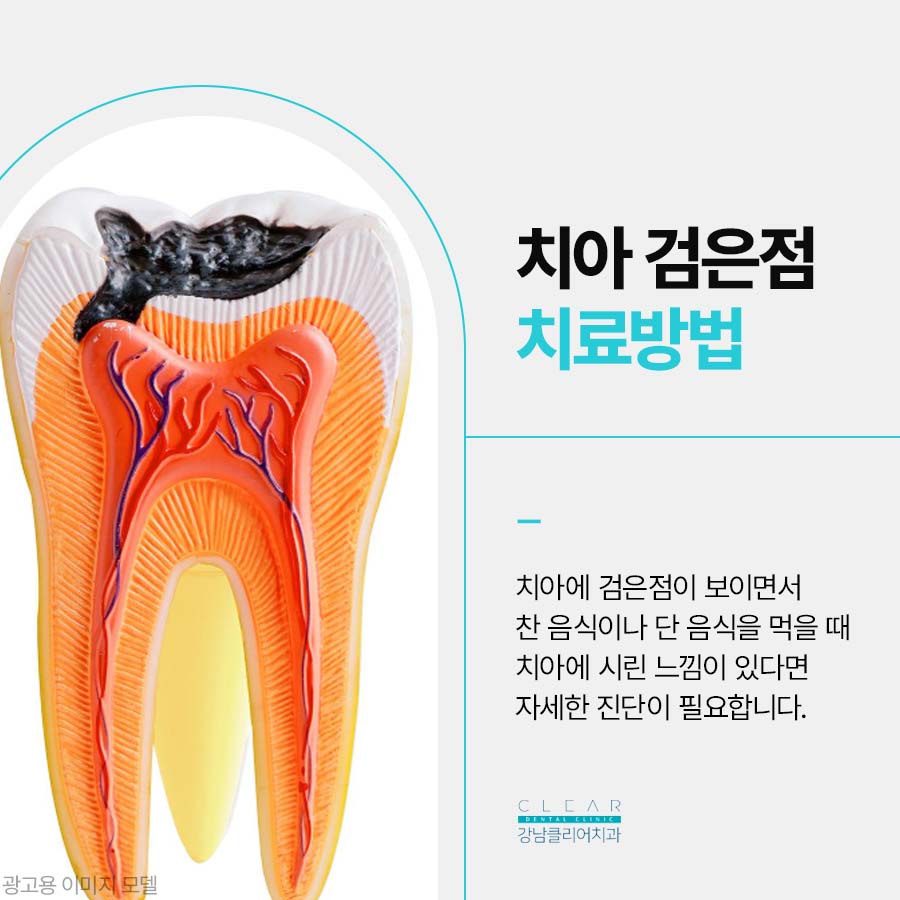 치아 검은점 원인 치료방법 정리 관련 이미지 3