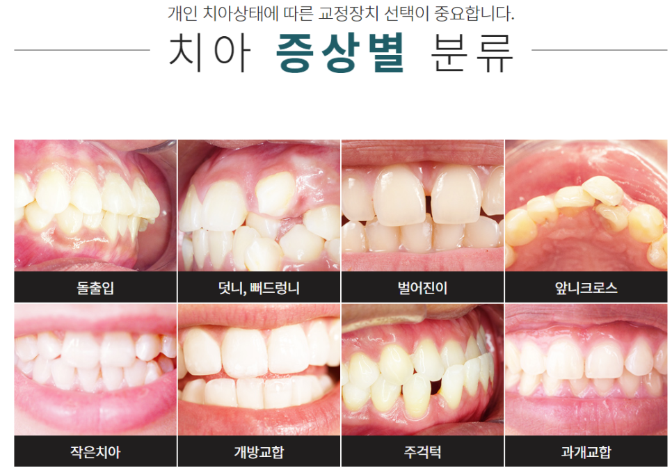 강남치아교정잘하는치과 가지런한 치아가 부럽다면 관련 이미지 2