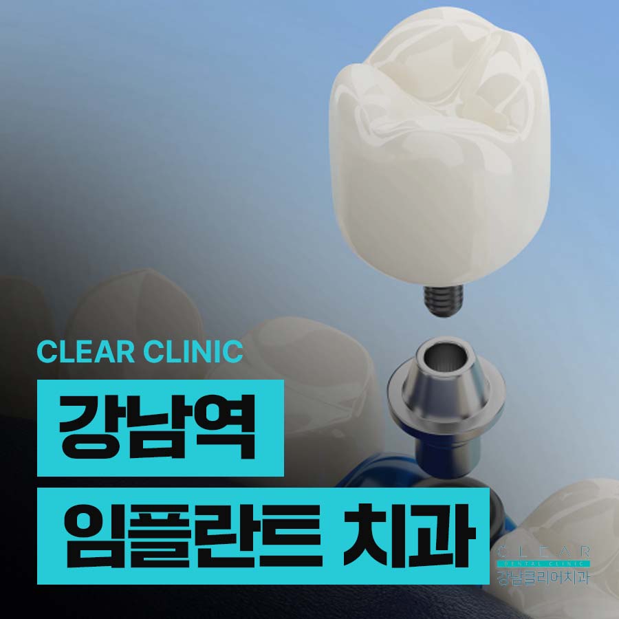 강남역 임플란트 치과 수술과정 및 시간 정리 관련 이미지 1