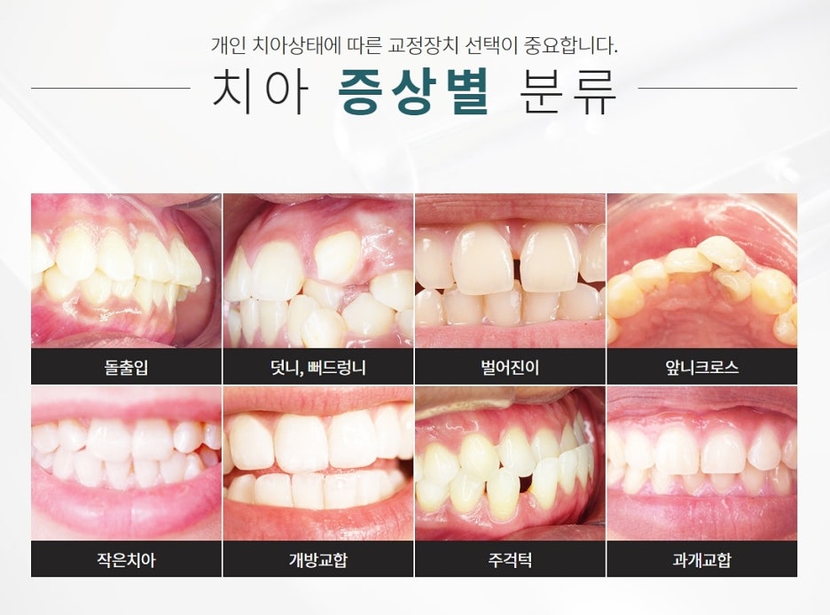 교정치과 강남클리어치과 선택은 신중히 관련 이미지 7