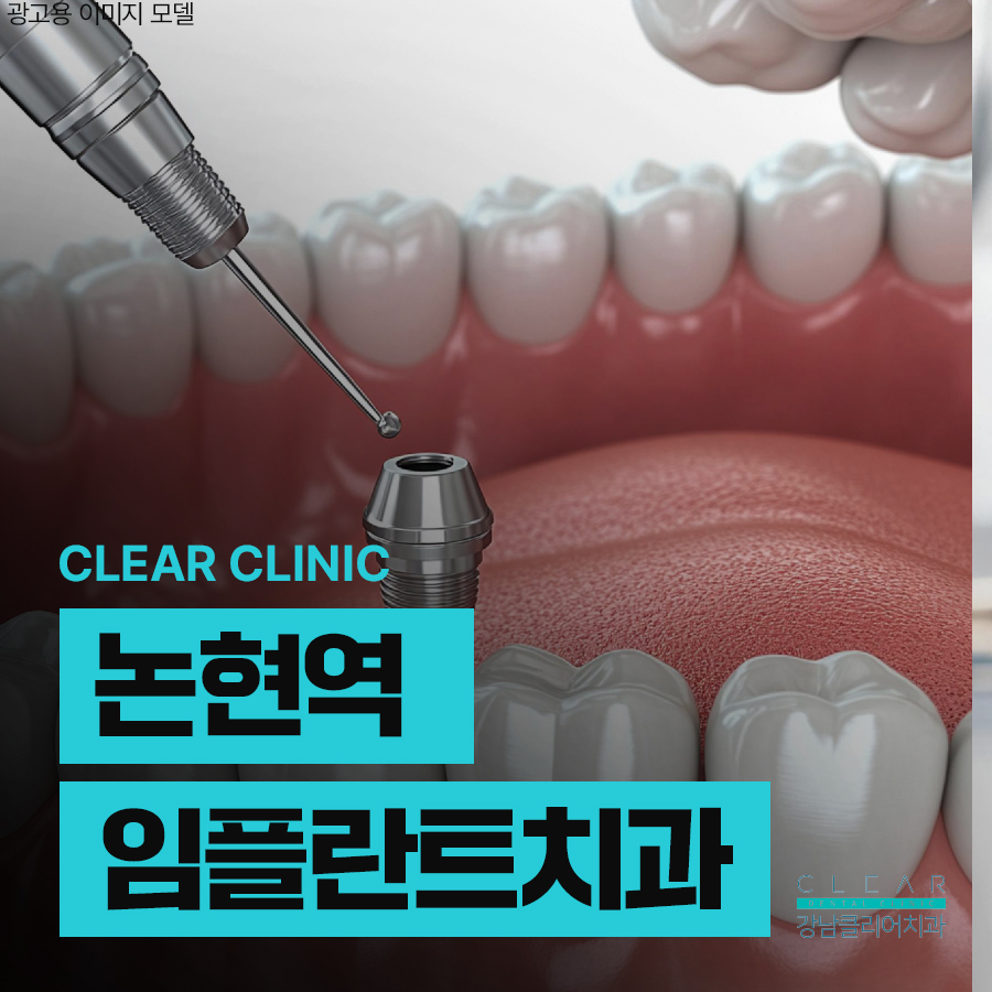 논현역 임플란트 치과 잇몸뼈가 좋지 않아도 관련 이미지 1