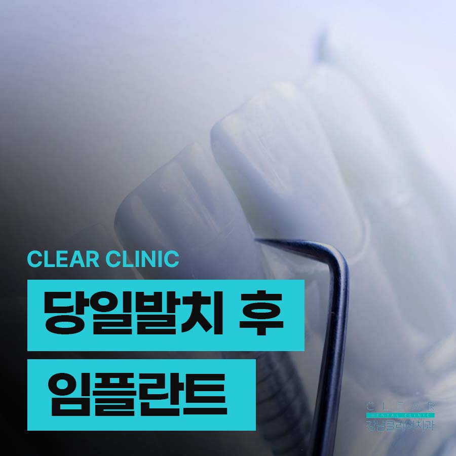 당일발치 후 임플란트 장점 정밀한 진단이 중요 관련 이미지 1