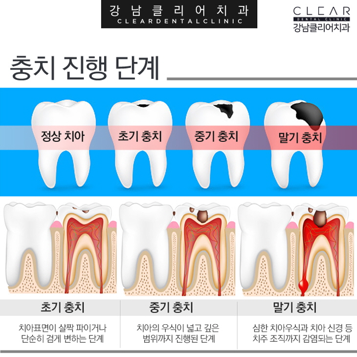 충치치료방법 단계별 필요한 보철치료까지 관련 이미지 2