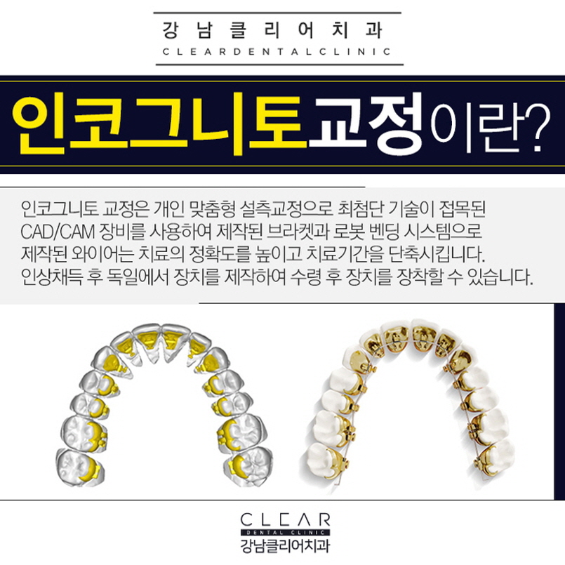강남역치아교정치과 나에게 맞는 장치 선택이 중요 관련 이미지 5