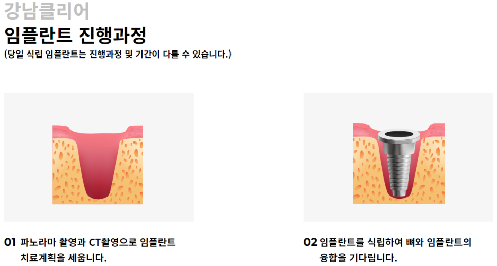 도곡동임플란트치과 불편함 없이 오래도록 사용 가능한 관련 이미지 5