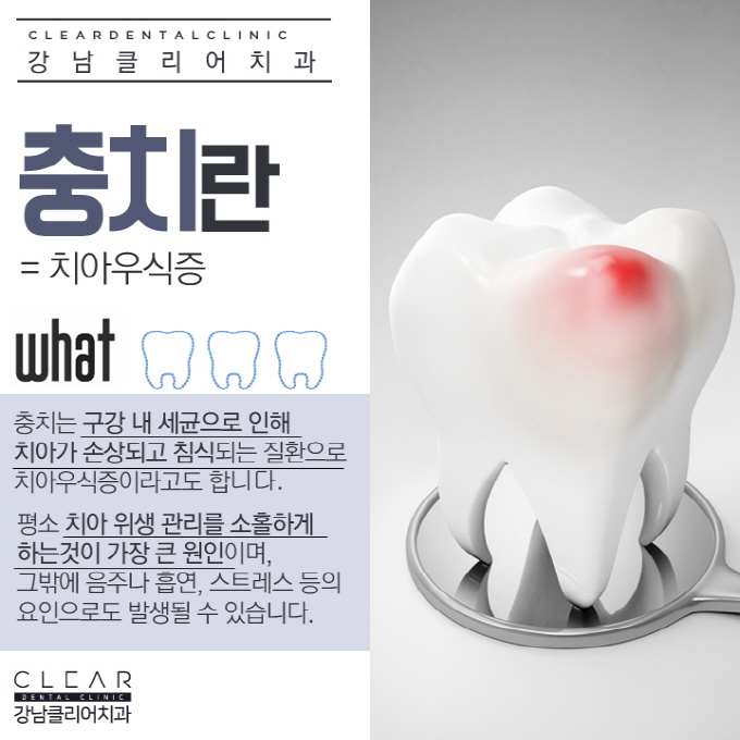 치아 스케일링 하는 이유, 효과, 주의사항 관련 이미지 5