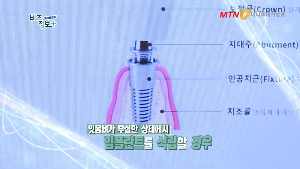 임플란트 주의사항 잇몸뼈의 상태도 봐야 관련 이미지 3