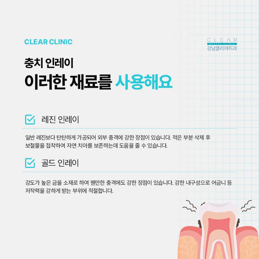 인레이 온레이 치료 다른점은 무엇일까 관련 이미지 5