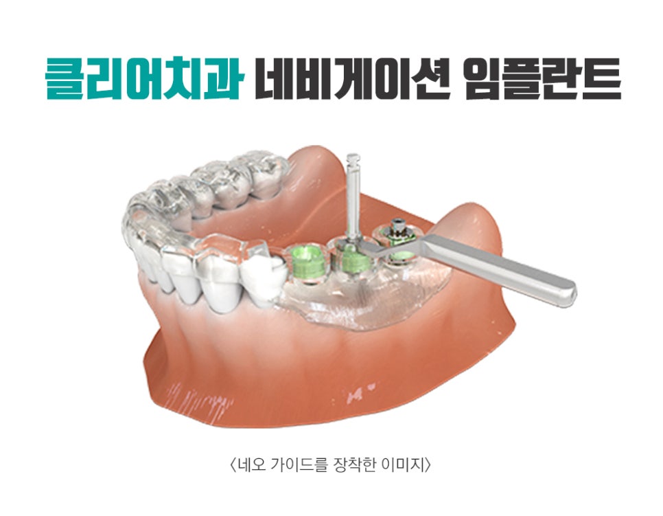 클리어치아상식 - 임플란트 대세는 네비게이션! 관련 이미지 2