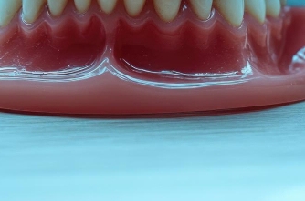 임플란트 빠졌을때 빠지는 이유 대처법 알려드려요 관련 이미지 22