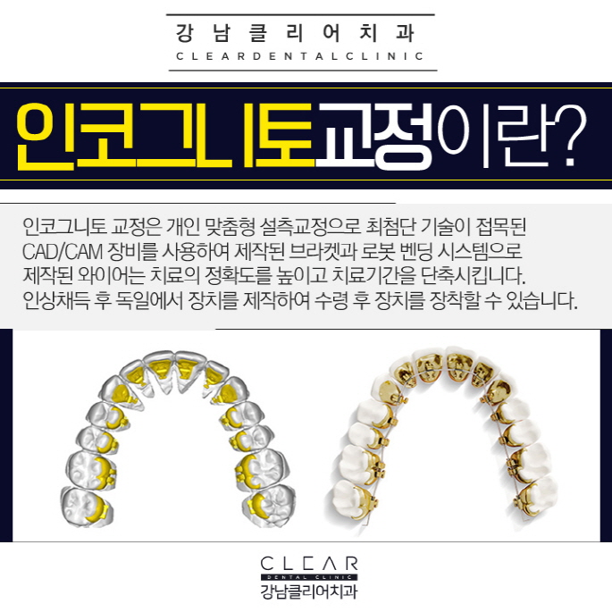 강남치아교정잘하는치과 치아교정종류 특징 관련 이미지 6