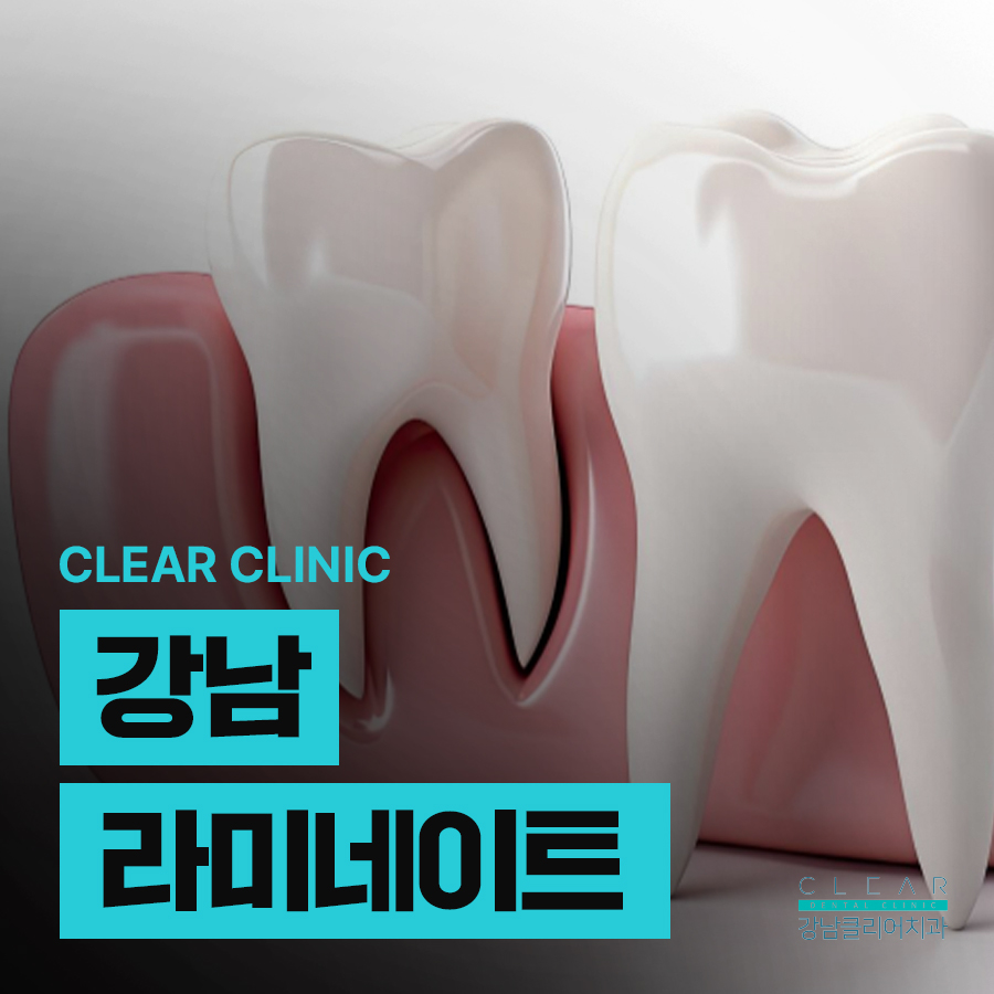 강남 라미네이트 뜻 치아삭제 주의해야 관련 이미지 1