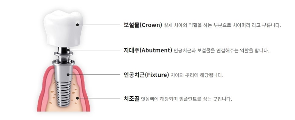 임플란트의 종류 남다른 방법 관련 이미지 4