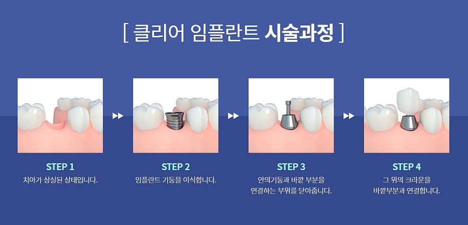 임플란트 강남역치과 준비된 곳을 가야지 관련 이미지 7