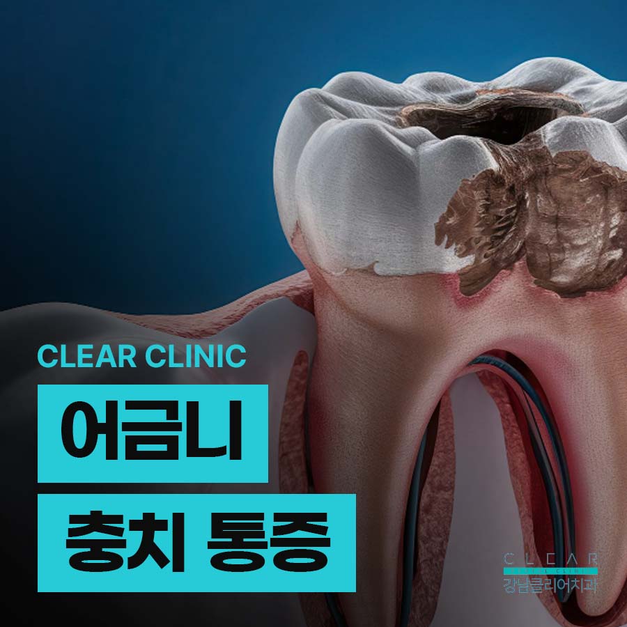 어금니 충치 통증 더 늦기 전에 시작해야 관련 이미지 1