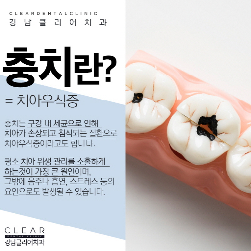 강남역충치치료 걱정보단 빠른 치료가 중요 관련 이미지 2