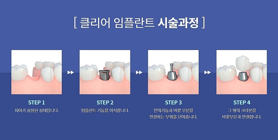 서울 임플란트치과 어디로 가볼까 관련 이미지 4