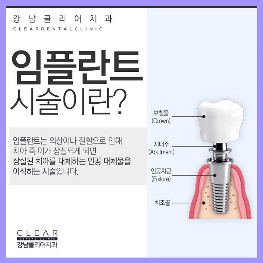 강남임플란트 찾아보고 결정하자 관련 이미지 3