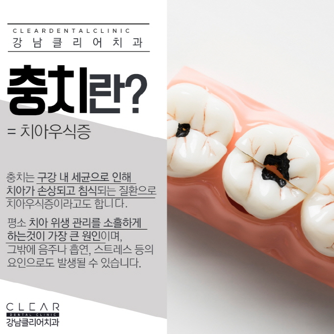 강남충치치료 레진, 인레이, 크라운 단계별 충치치료 관련 이미지 3