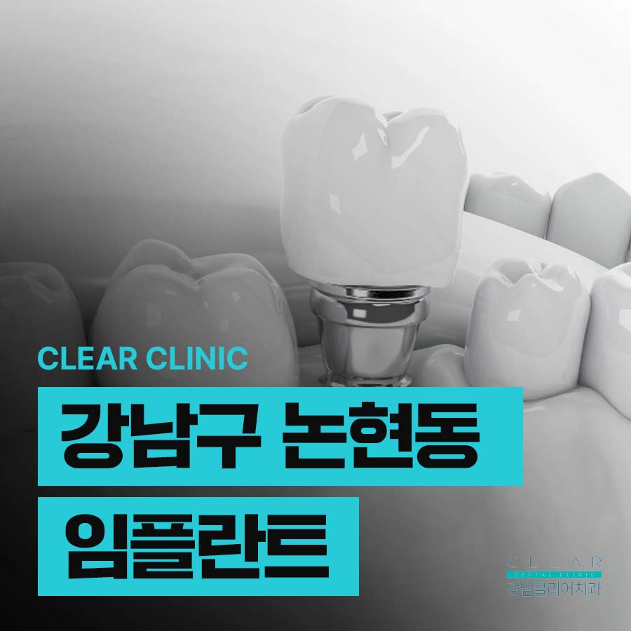 강남구 논현동 임플란트 장단점 분석 관련 이미지 1