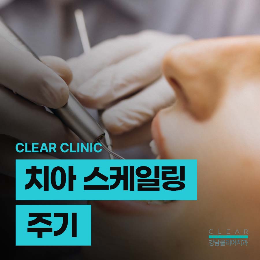 치아 스케일링 주기 적절한 정도 방법에 대해 관련 이미지 1