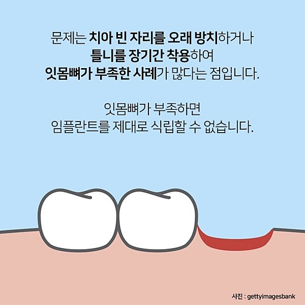 잇몸뼈가 부족해 임플란트 수술 어렵다면? 관련 이미지 3