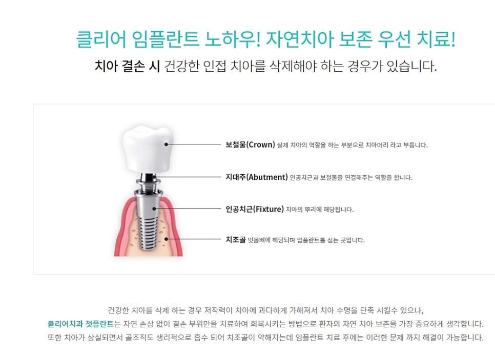 클리어치과 임플란트 이젠 고민 그만하고 관련 이미지 5