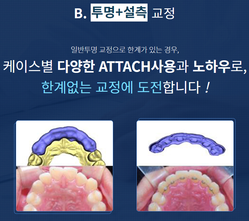 역삼동 부정교합 어떤 치료를 해야 할까? 관련 이미지 5