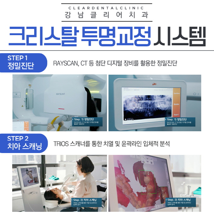 강남투명교정 치과 기존 투명교정 문제점 보완 관련 이미지 5