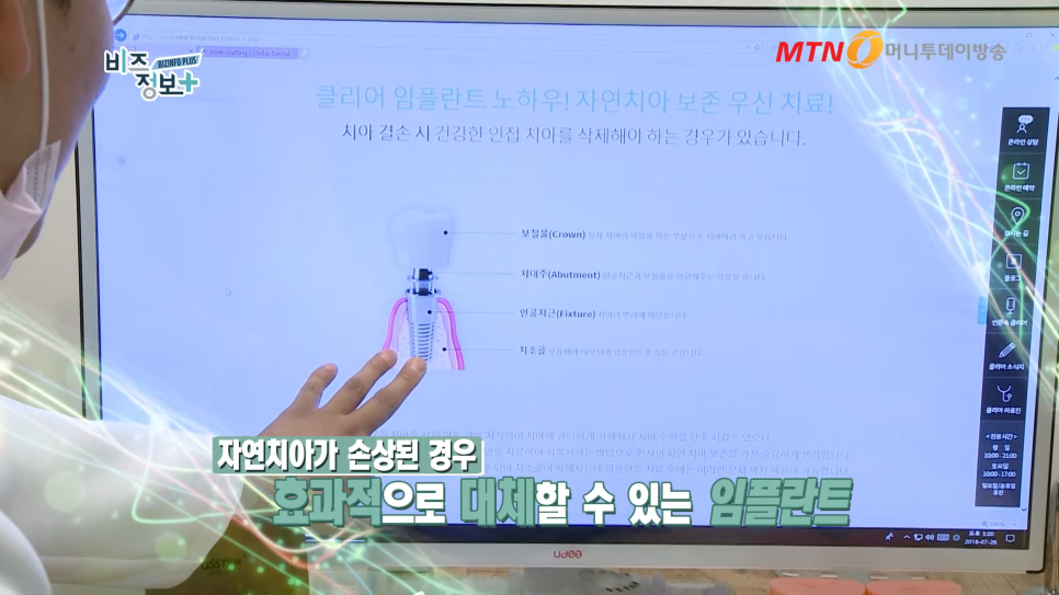 임플란트 주의사항 잇몸뼈의 상태도 봐야 관련 이미지 2