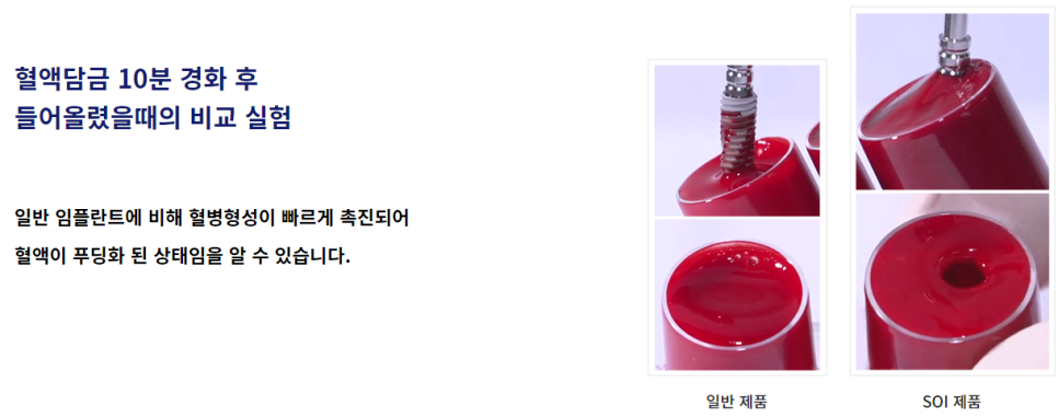 강남역임플란트치과 치아를 보다 오래 사용할 수 있도록 관련 이미지 5
