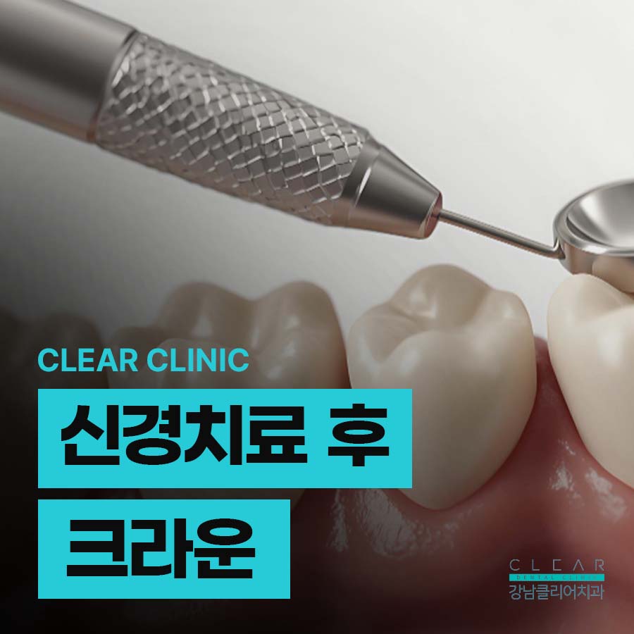 신경치료 후 크라운 꼭 해야되는 이유 관련 이미지 1