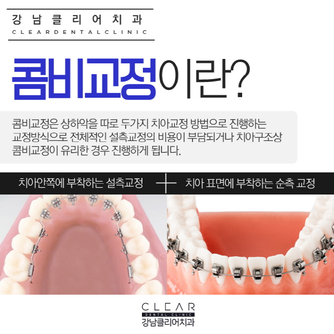 강남치아교정잘하는치과 치아교정종류 특징 관련 이미지 7