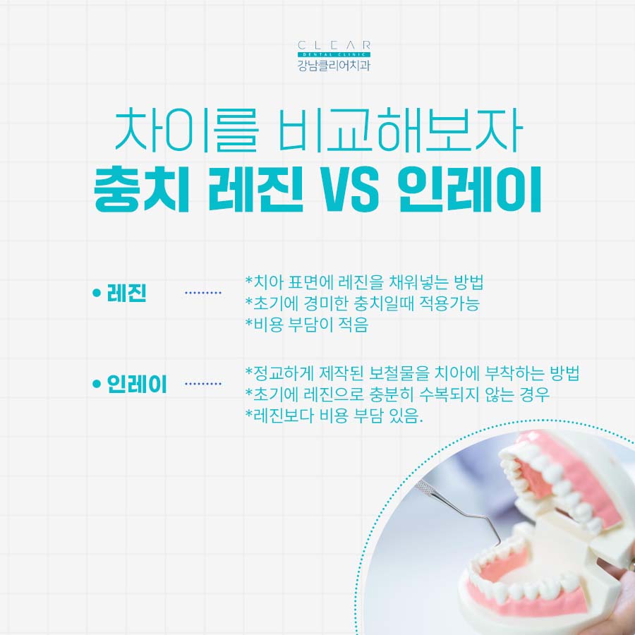 논현동 치과 충치 치료방법 레진 인레이 차이점 비교 관련 이미지 4