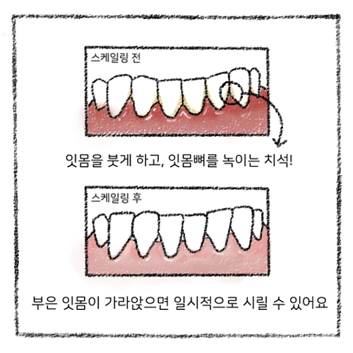 치아 스케일링 보험적용, 가격, 스케일링 후 주의사항 관련 이미지 16