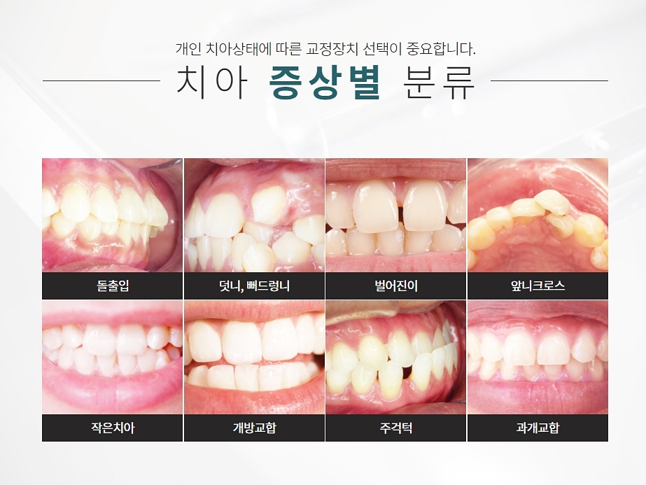 교정은 강남클리어치과 고민하지 않도록 관련 이미지 6