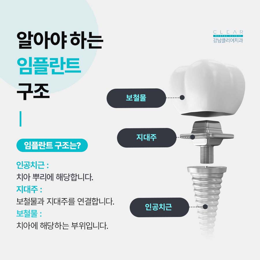 강남역 치과 임플란트 구조와 치료기간 관련 이미지 2