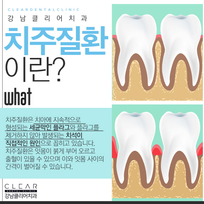 치아 스케일링 가격 건강보험 적용으로 부담없이 관련 이미지 6