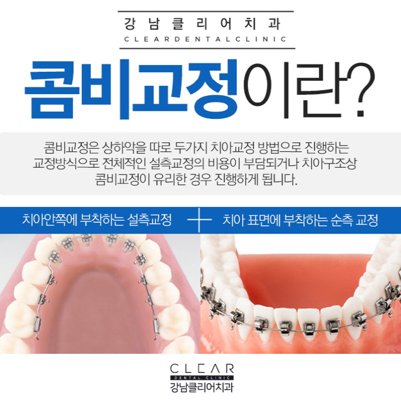강남역치아교정치과 가지런한 치아 만드는 교정방법들 관련 이미지 7