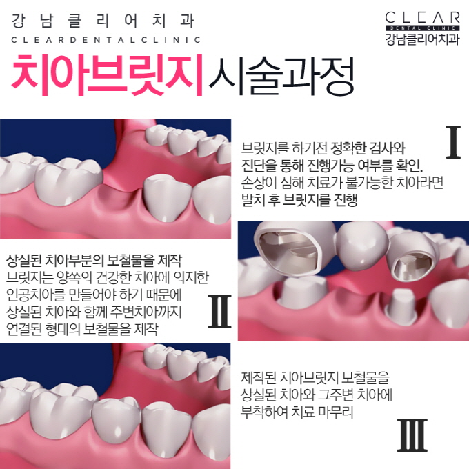 치아브릿지 강남치아브릿지도 이제 맞춤형으로 관련 이미지 4