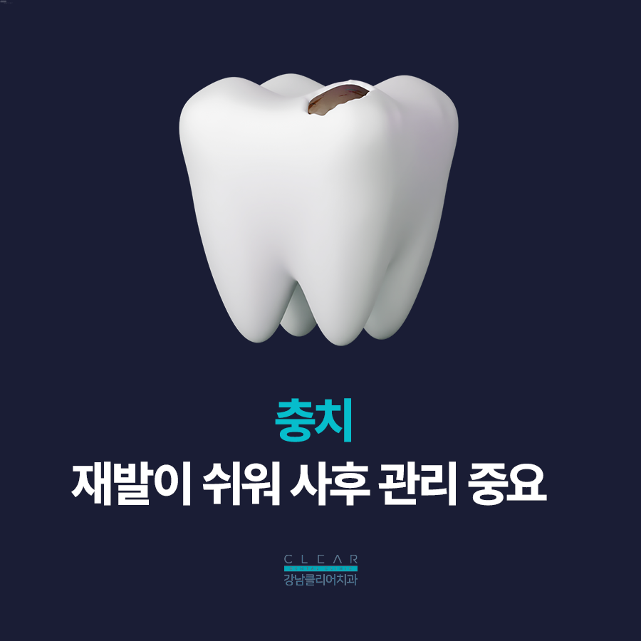 강남 레진치료 여름철 충치 사례 증가 주의가 필요합니다 관련 이미지 5