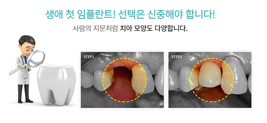 서울 임플란트치과 어디로 가볼까 관련 이미지 6