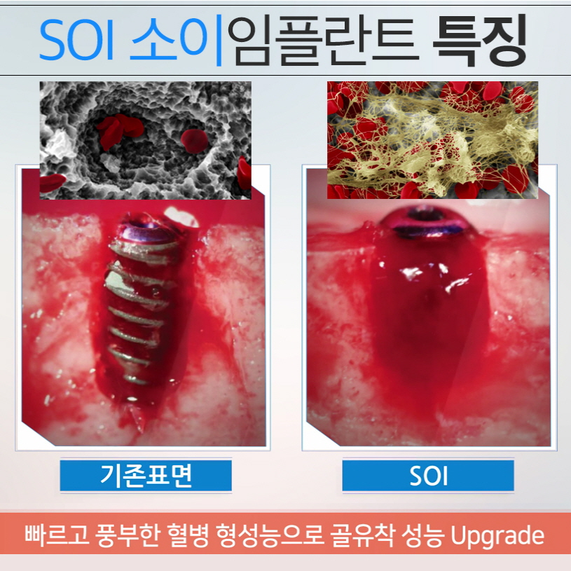 오스템임플란트 SOI임플란트 무엇이 다를까요? 관련 이미지 3