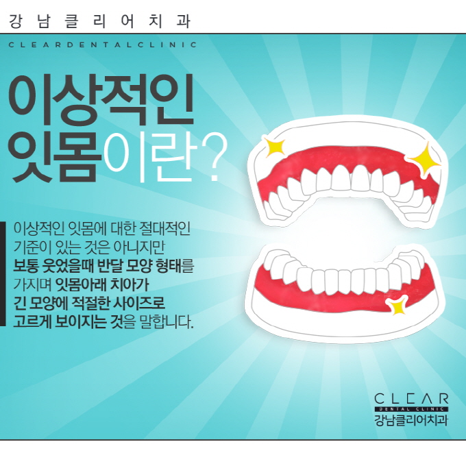 연예인잇몸성형, 잇몸성형 자신감 있는 미소 되찾기 관련 이미지 3