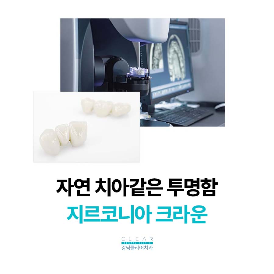 앞니 임플란트 치료기간 얼마나 걸릴까 관련 이미지 6