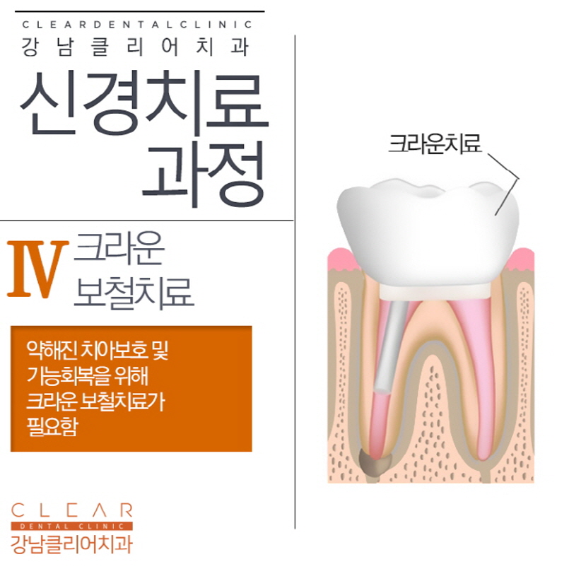강남신경치료 늦어지면 안돼는 중요한 치료 관련 이미지 7