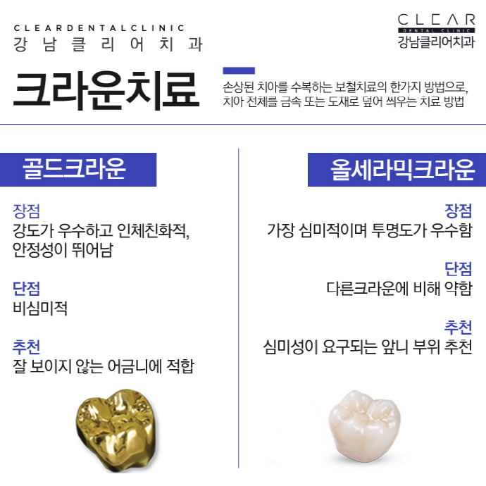 치아보철치료 치아보철종류 융시크 체험기 관련 이미지 6